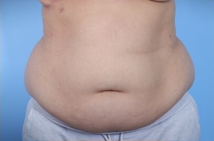 Before Image: Patient 5 - front