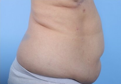 Before Image: Patient 5 - right-side