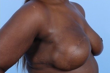 After Image: Patient 6 - right-front-oblique