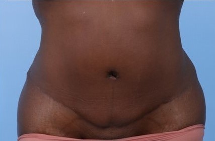 After Image: Patient 6 - front