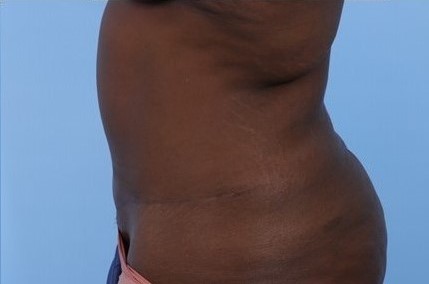After Image: Patient 6 - left-side