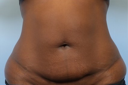 Before Image: Patient 6 - front