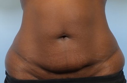 Before Image: Patient 6 - front