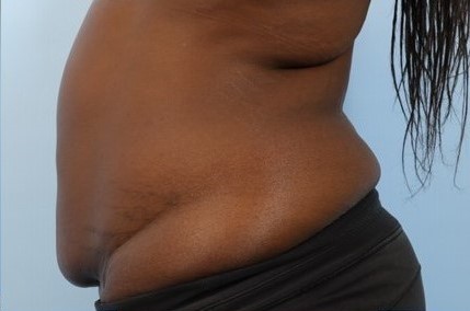 Before Image: Patient 6 - left-side