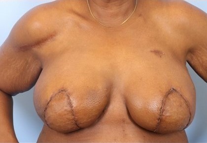 After Image: Patient 7 - front