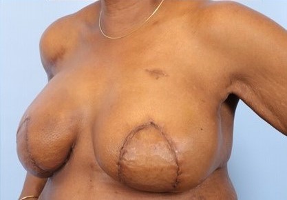 After Image: Patient 7 - left-front-oblique