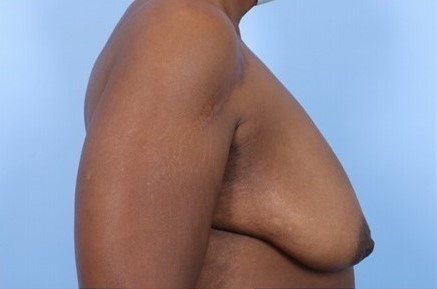 Before Image: Patient 7 - right-side