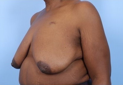 Before Image: Patient 7 - left-front-oblique