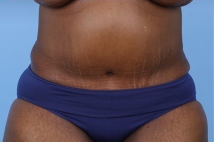 After Image: Patient 7 - front