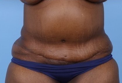 After Image: Patient 7 - front