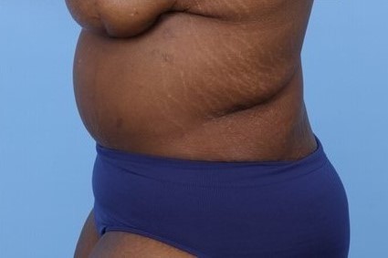 After Image: Patient 7 - left-side