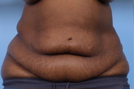Before Image: Patient 7 - front