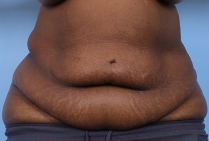 Before Image: Patient 7 - front