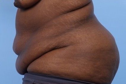 Before Image: Patient 7 - left-side