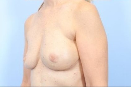 After Image: Patient 8 - left-front-oblique