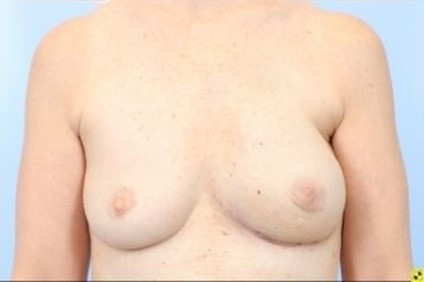 After Image: Patient 8 - front