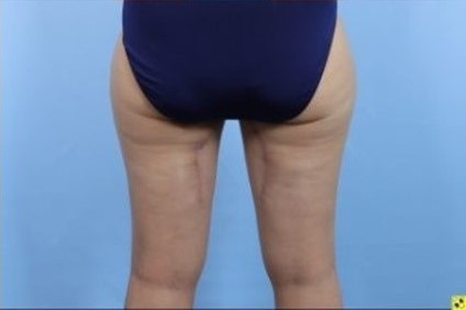 After Image: Patient 8 - back