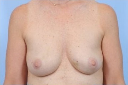 Before Image: Patient 8 - front
