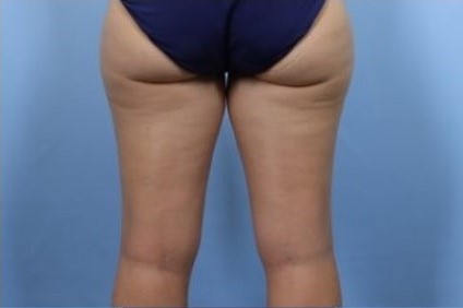 Before Image: Patient 8 - back