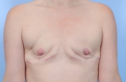 Before Image: Patient 9 - front