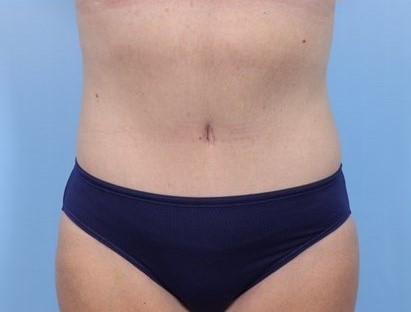 After Image: Patient 16 - front
