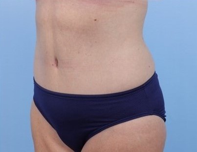 After Image: Patient 16 - left-front-oblique