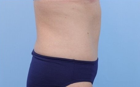 After Image: Patient 16 - right-side
