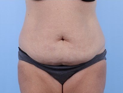 Before Image: Patient 16 - front