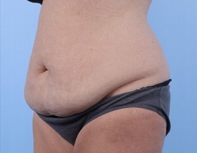 Before Image: Patient 16 - left-front-oblique