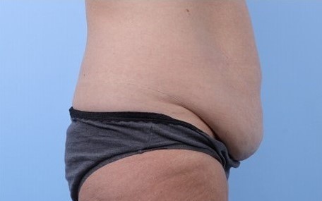 Before Image: Patient 16 - right-side