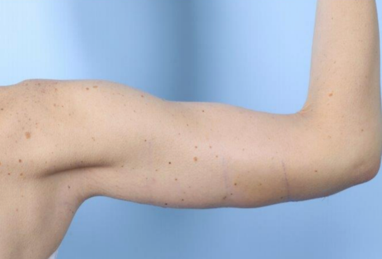 After Image: Brachioplasty - right-side