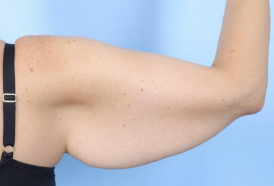 Before Image: Brachioplasty - right-side