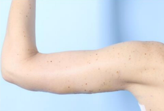 After Image: Brachioplasty - left-side