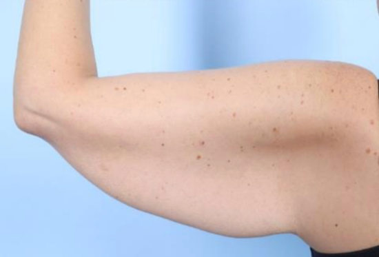 Before Image: Brachioplasty - left-side